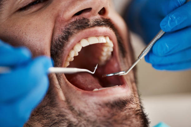 Best Emergency Dentist for Lost Fillings or Crowns in Hoover, AL